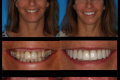 Anterior Aesthetics- Dr. Paul Peterson-