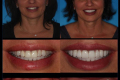 Anterior Aesthetics- Dr. Paul Peterson--