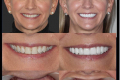 Anterior Aesthetics- Dr. Robert Klaich