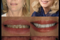 Anterior Aesthetics-Dr. Tina Chandra-