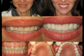 Full Mouth-Dr. Pamela Marzban