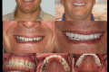 Full Mouth-Dr. Raul Garcia-