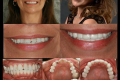 Full Mouth-Dr. Tina Chandra-