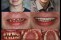 Full Mouth-Dr. Tina Chandra