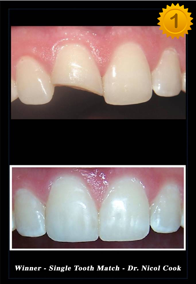 Single Tooth Match-Dr. Nicol Cook -Category Winner