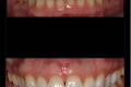 Single Tooth Match-Dr. Paul Peterson-