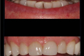 Single Tooth Match-Dr. Paul Peterson