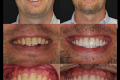 Category I Anterior Aesthetics - Dr. Brian Klaich