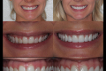 Category I Anterior Aesthetics - Dr. Frank Sullivan