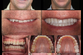 Category II - Full Mouth-Full Arch - Dr. John Barras