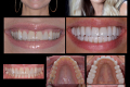 Category II - Full Mouth - Full Arch - Dr. Kent White