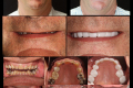 Category II Full Mouth - Full Arch - Dr. John Barras