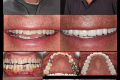 Category II -Full Mouth -Full Arch - Dr. Michael Adler