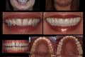 Category II - Full Mouth - Full Arch - Dr. Paul Peterson