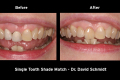 Category IV Single Tooth Shade Match - Dr. David Schmidt