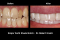 Category IV Single Tooth Shade Match - Dr. Robert Klaich